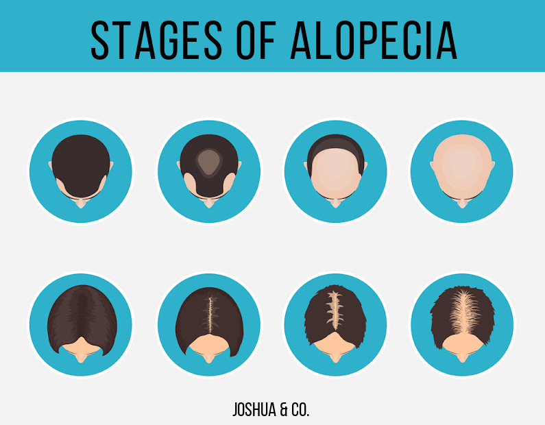 diagram of increasing stages of hair loss